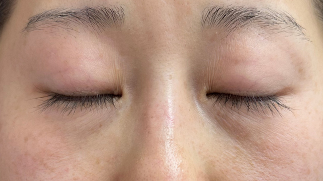 手术前的状态 其一