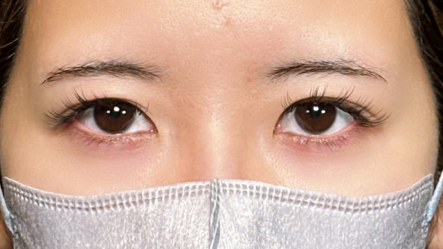 手术前的状态 其一