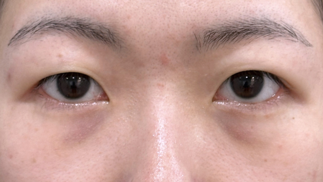 手術前の状態 その1