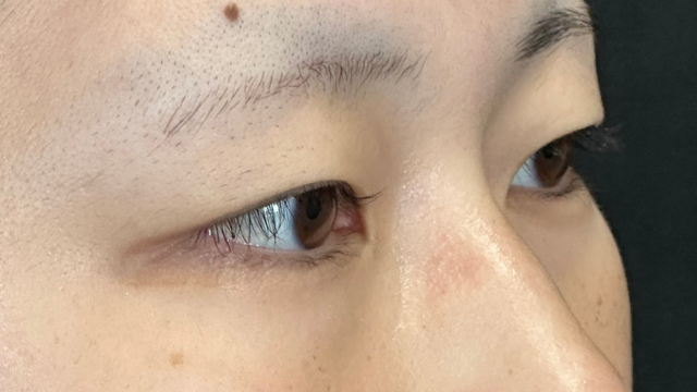 手術前の状態 その1