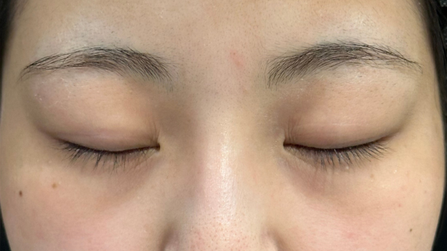 手術前の状態 その1