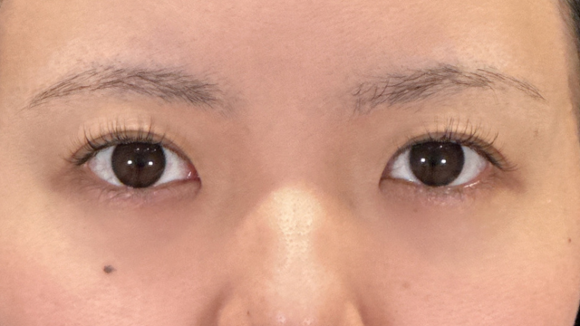 手術前の状態 その1