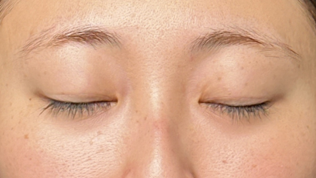 手術前の状態 その1