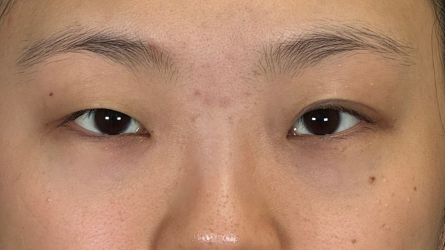 手術前の状態 その1