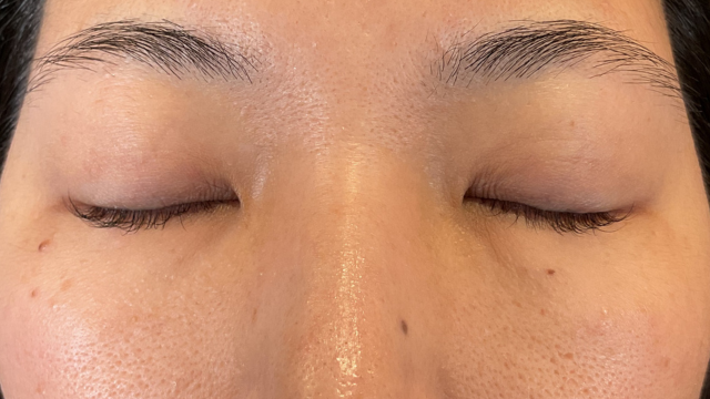 手術前の状態 その1