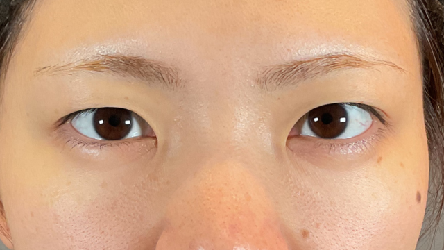 手术前的状态 其一