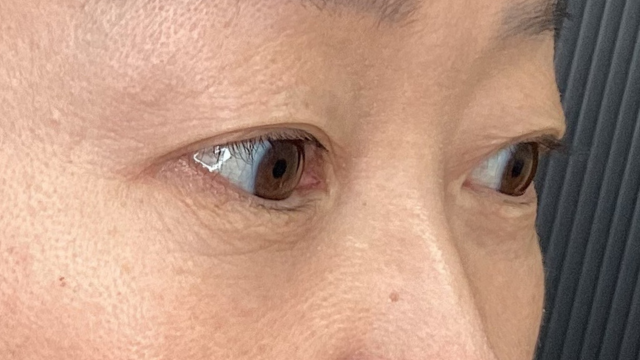 手術前の状態 その1