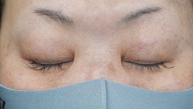 手术前的状态 其一