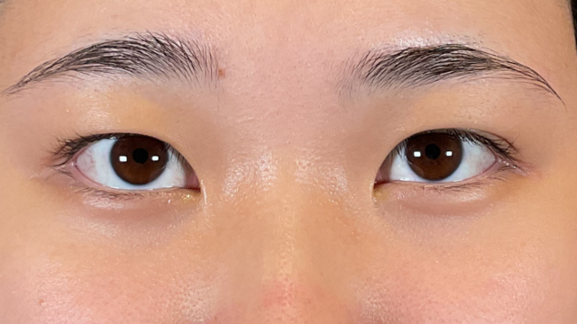 手術前の状態 その1