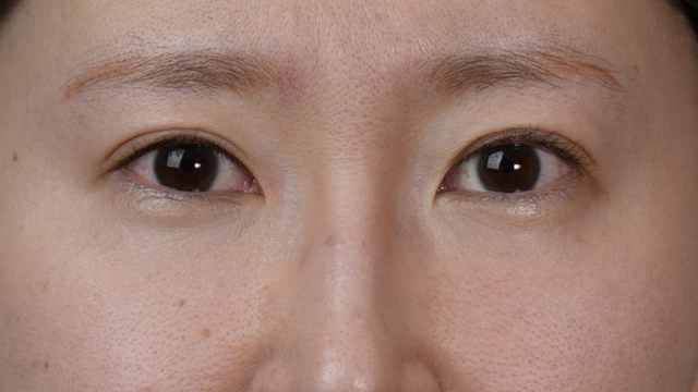 手术前的状态 其一