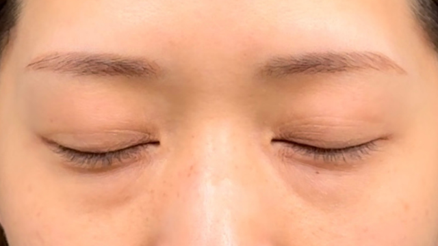 手術前の状態 その1