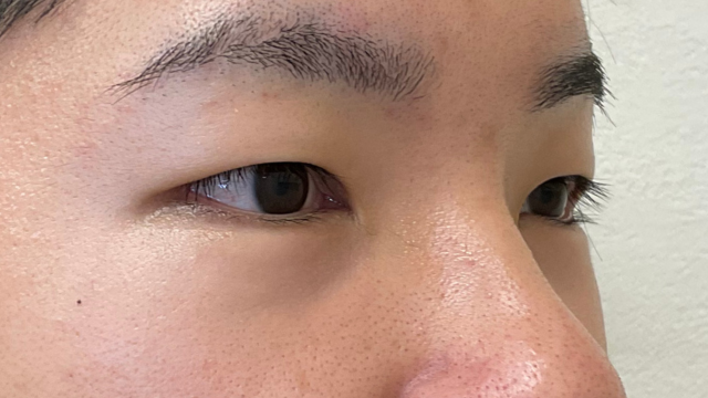 手術前の状態 その1