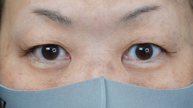 手术前的状态 其一