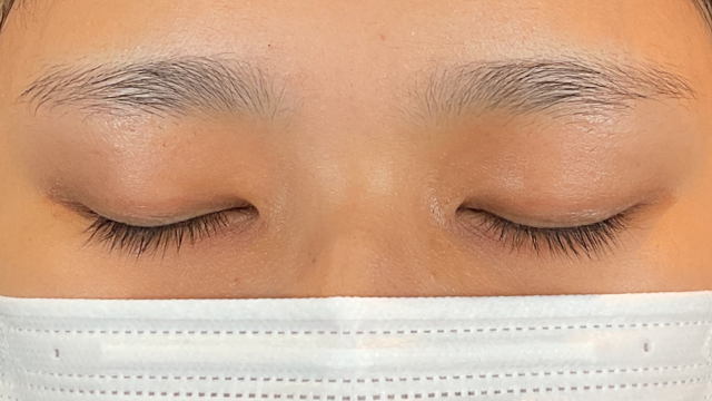 手術前の状態 その1