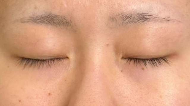 手术前的状态 其一