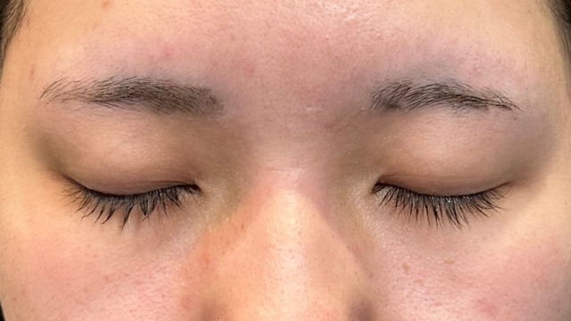 手術前の状態 その1