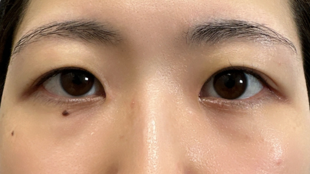 手术前的状态 其一