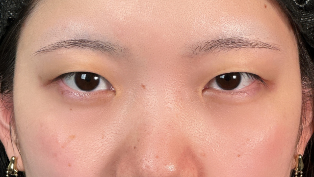 手术前的状态 其一