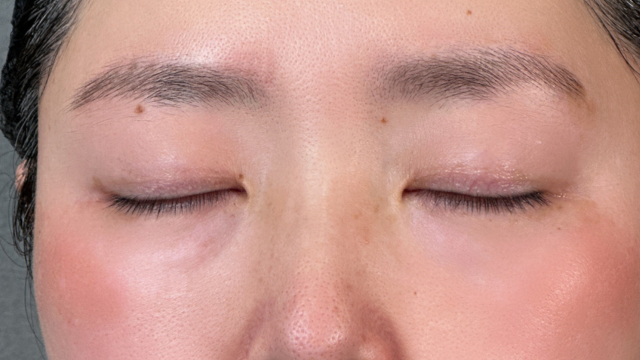 手術前の状態 その1