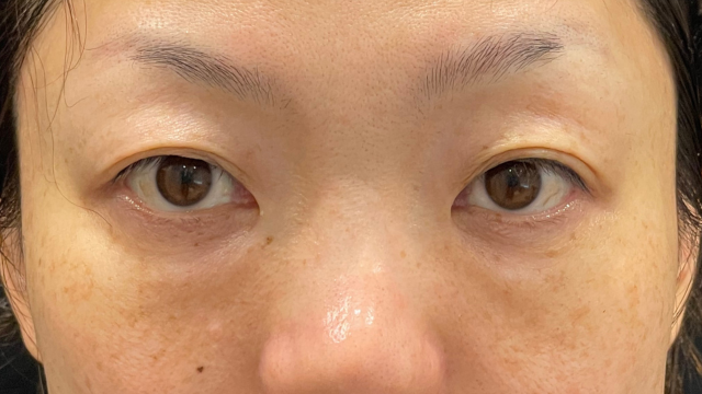 手術前の状態 その1