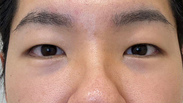 手術前の状態 その1