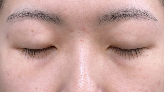 手術前の状態 その1