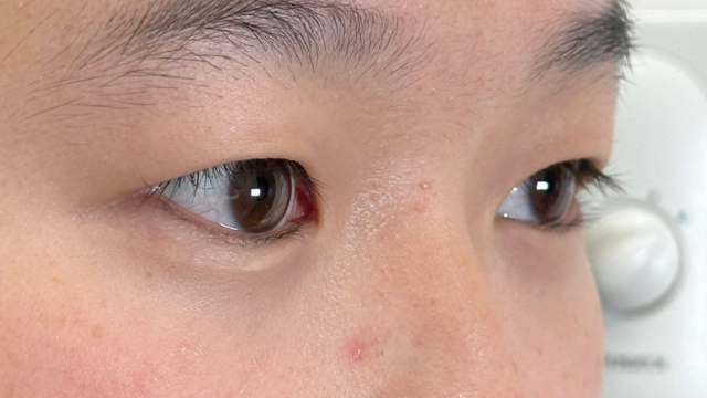 手术前的状态 其一