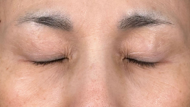 手術前の状態 その1