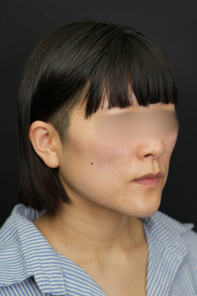 手術前の状態 その1