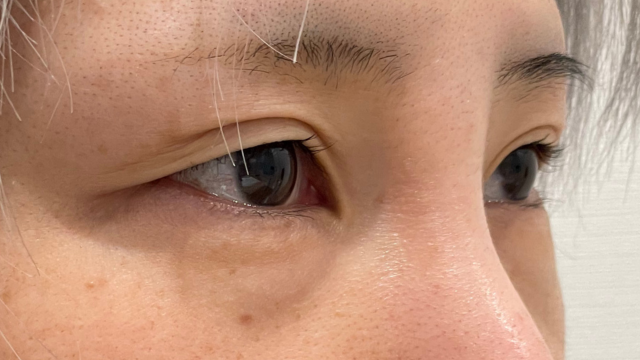 手術前の状態 その1