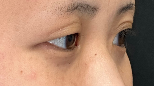 手术前的状态 其一