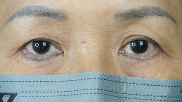 手术前的状态 其一