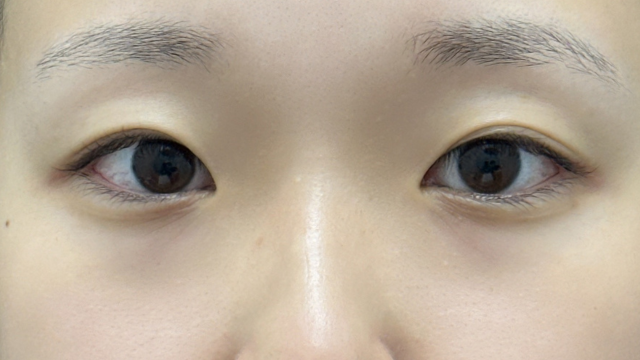 手术前的状态 其一