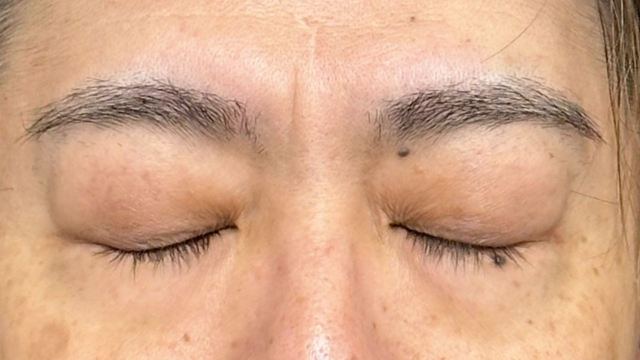 手術前の状態 その1