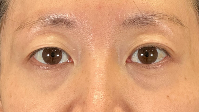 手術前の状態 その1