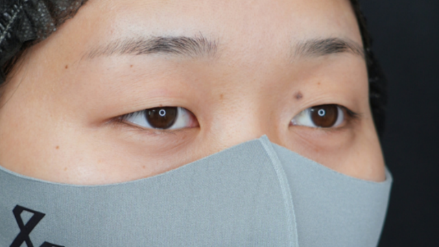 手術前の状態 その1