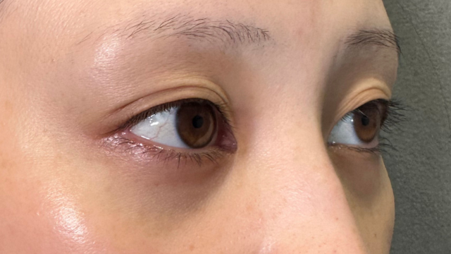 手术前的状态 其一