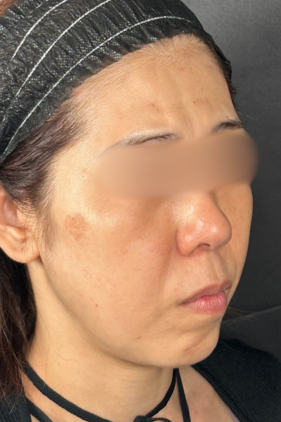 手術前の状態 その1