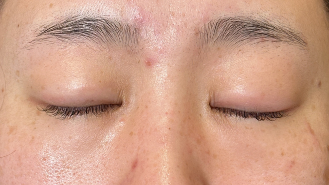 手术前的状态 其一