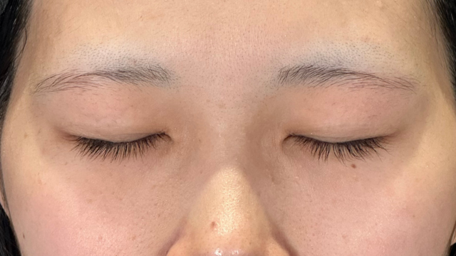 手術前の状態 その1