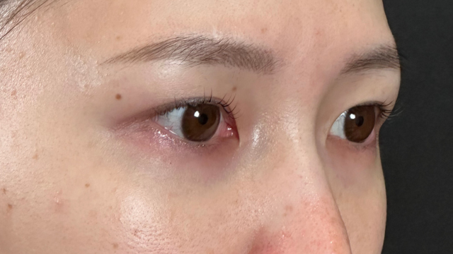 手术前的状态 其一