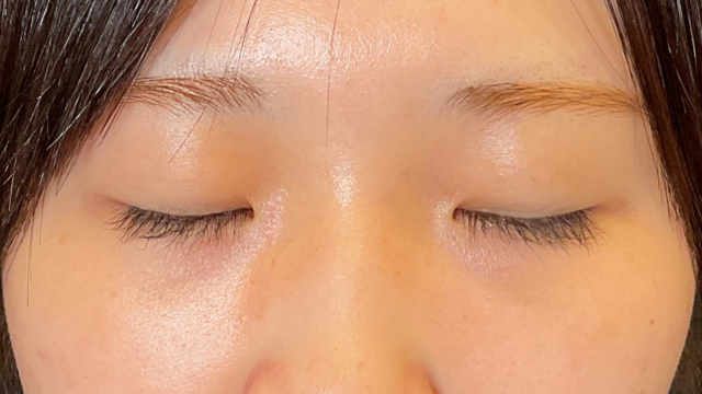 手术前的状态 其一