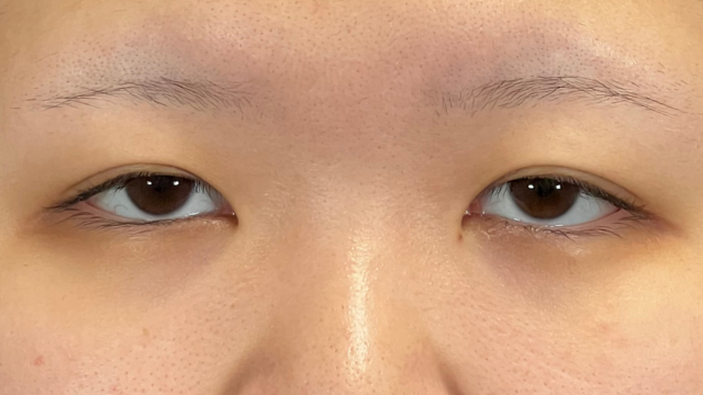 手术前的状态 其一