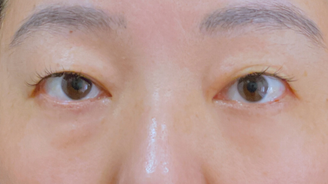 手術前の状態 その1