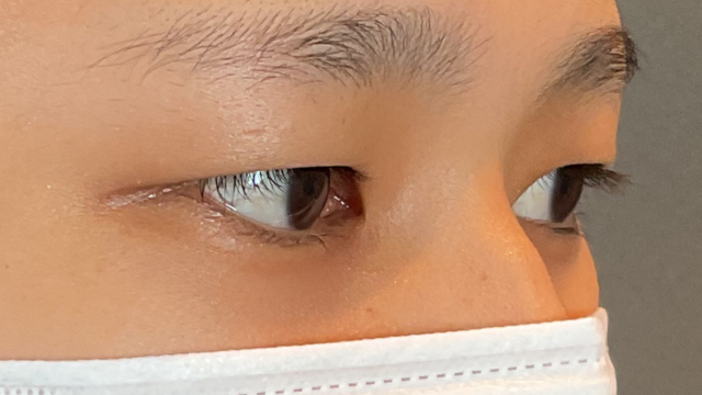 手術前の状態 その1