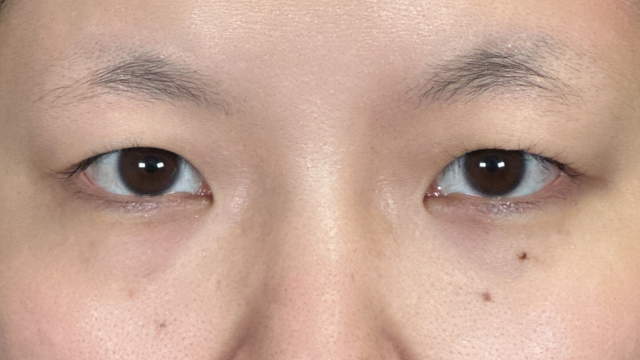 手术前的状态 其一