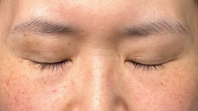 手術前の状態 その1