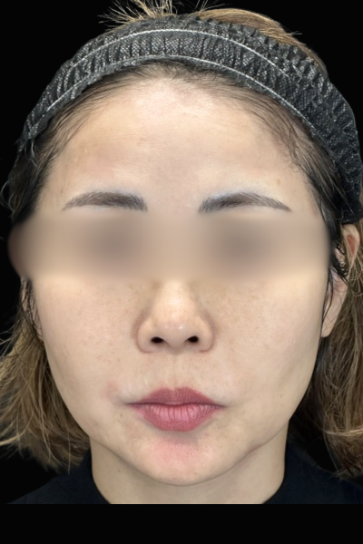 手術前の状態 その1