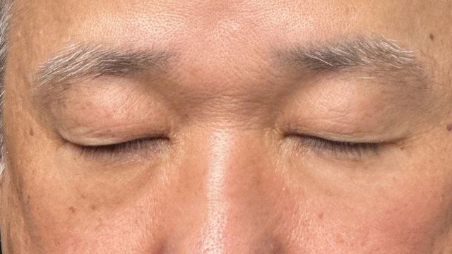 手术前的状态 其一