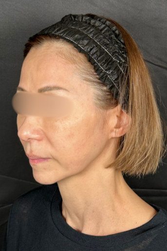 手術前の状態 その1